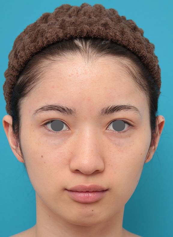 額形成（人工骨セメント）,人工骨セメントで額形成手術を行い、平らなおでこをぽっこり丸くした症例写真,After（2ヶ月後）,ba_hitaicement002_a01.jpg