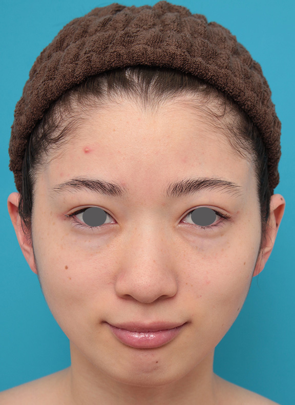 額形成（人工骨セメント）,人工骨セメントで額形成手術を行い、平らなおでこをぽっこり丸くした症例写真,Before,ba_hitaicement002_b01.jpg