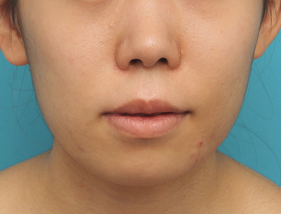 唇を薄く（口唇縮小術）,上下の厚い唇を口唇縮小手術で薄くした症例写真,After（6ヶ月後）,ba_usuku009_b02.jpg