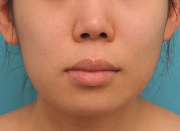 上下の厚い唇を口唇縮小手術で薄くした症例写真,Before,ba_usuku009_b01.jpg