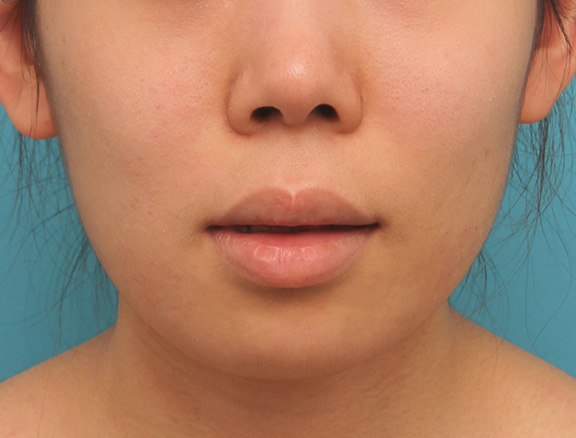 唇を薄く（口唇縮小術）,上下の厚い唇を口唇縮小手術で薄くした症例写真,Before,ba_usuku009_b02.jpg
