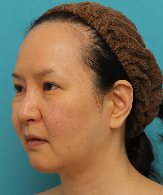 脂肪吸引,顔の脂肪吸引をし、小顔になってたるみも改善した40代女性の症例写真,After（6ヶ月後）,ba_shibo004_b02.jpg