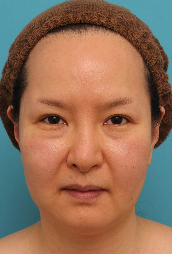 脂肪吸引,顔の脂肪吸引をし、小顔になってたるみも改善した40代女性の症例写真,Before,ba_shibo004_b01.jpg