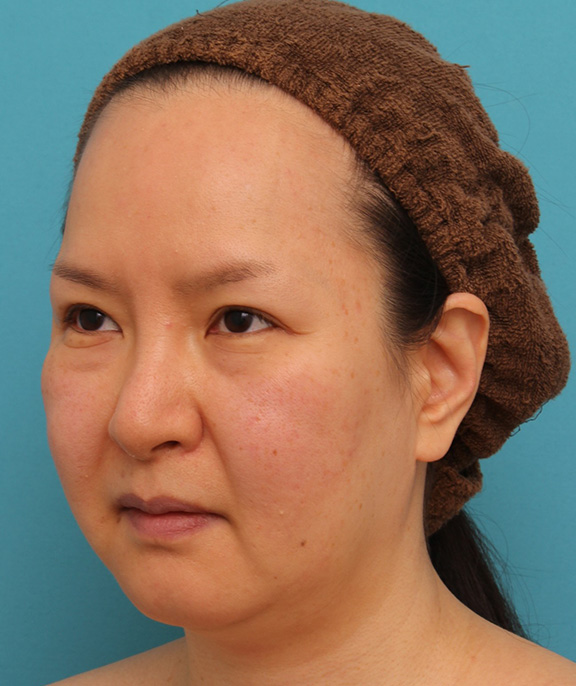 脂肪吸引,顔の脂肪吸引をし、小顔になってたるみも改善した40代女性の症例写真,Before,ba_shibo004_b02.jpg