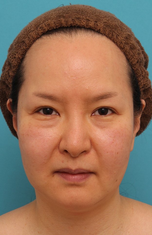 脂肪吸引（頬、あご）,顔の脂肪吸引をし、小顔になってたるみも改善した40代女性の症例写真,手術前,mainpic_shibo004a.jpg