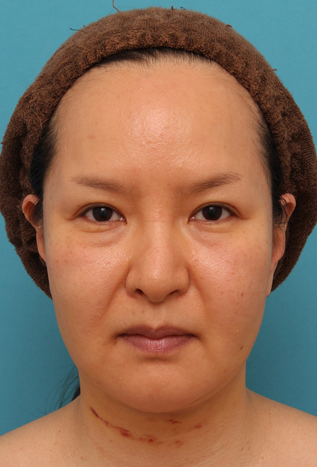 症例写真,顔の脂肪吸引をし、小顔になってたるみも改善した40代女性の症例写真,6日後,mainpic_shibo004c.jpg