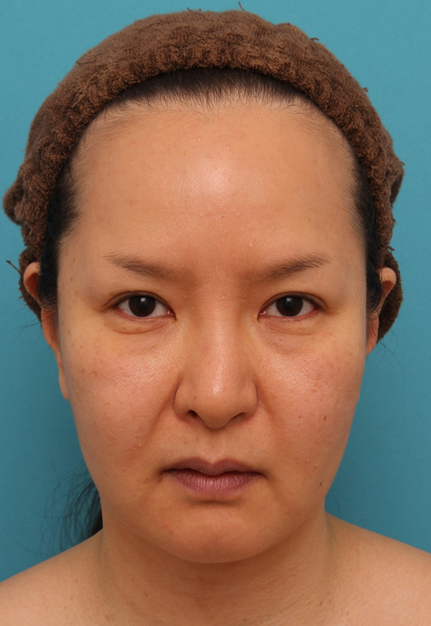 脂肪吸引（頬、あご）,顔の脂肪吸引をし、小顔になってたるみも改善した40代女性の症例写真,3週間後,mainpic_shibo004d.jpg