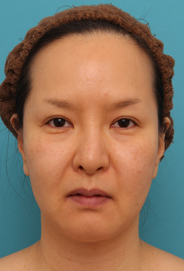 脂肪吸引,顔の脂肪吸引をし、小顔になってたるみも改善した40代女性の症例写真,6ヶ月後,mainpic_shibo004e.jpg