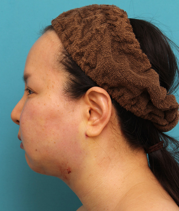 脂肪吸引（頬、あご）,顔の脂肪吸引をし、小顔になってたるみも改善した40代女性の症例写真,手術直後,mainpic_shibo004g.jpg