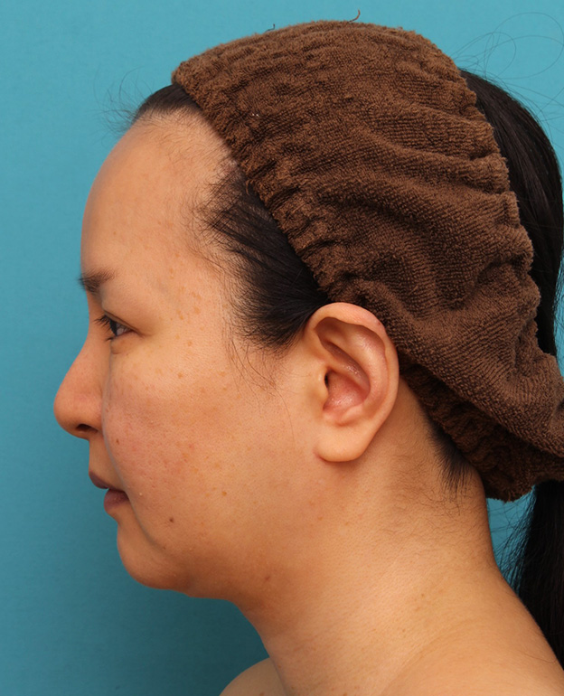 脂肪吸引（頬、あご）,顔の脂肪吸引をし、小顔になってたるみも改善した40代女性の症例写真,3週間後,mainpic_shibo004i.jpg