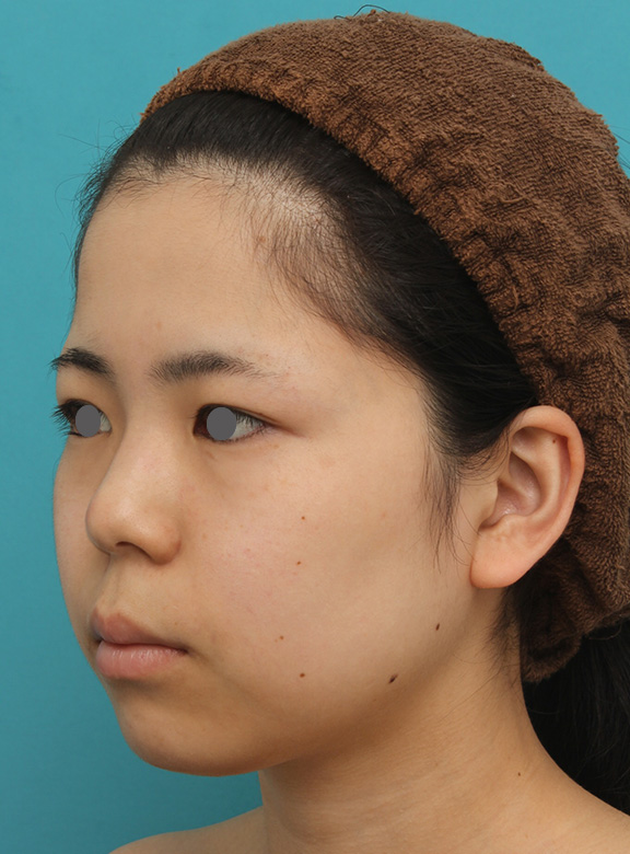 脂肪吸引（頬、あご）,頬、顎下の脂肪吸引をし、下膨れの顔の輪郭が改善した症例写真,Before,ba_shibo005_b02.jpg