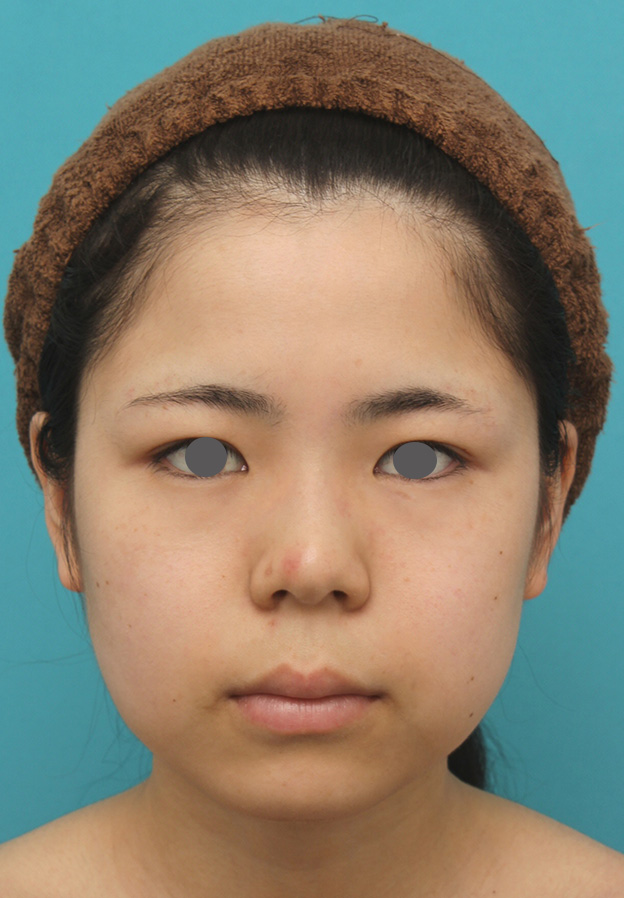 脂肪吸引,頬、顎下の脂肪吸引をし、下膨れの顔の輪郭が改善した症例写真,手術前,mainpic_shibo005a.jpg