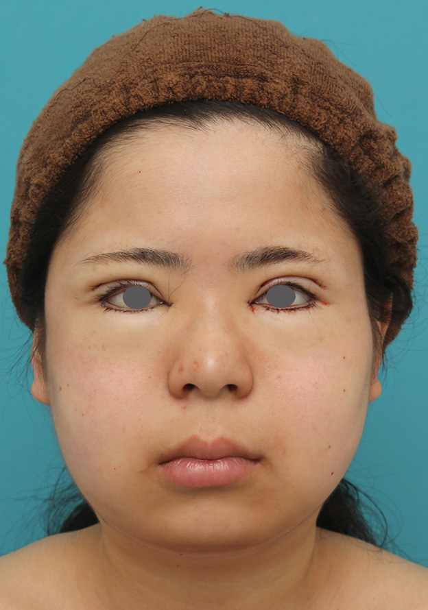 脂肪吸引,頬、顎下の脂肪吸引をし、下膨れの顔の輪郭が改善した症例写真,手術直後,mainpic_shibo005b.jpg