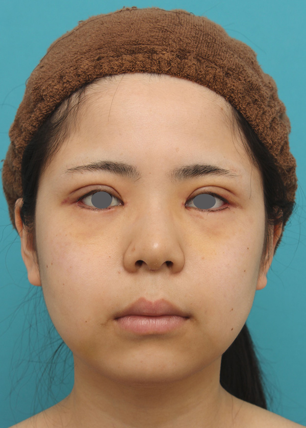 脂肪吸引（頬、あご）,頬、顎下の脂肪吸引をし、下膨れの顔の輪郭が改善した症例写真,6日後,mainpic_shibo005c.jpg