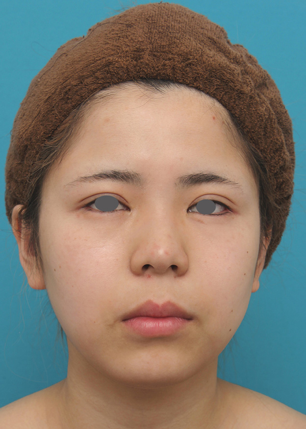 脂肪吸引（頬、あご）,頬、顎下の脂肪吸引をし、下膨れの顔の輪郭が改善した症例写真,6ヶ月後,mainpic_shibo005d.jpg
