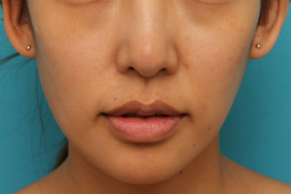 ヒアルロン酸で唇を厚く（ふっくら・アヒル口etc）,上唇にヒアルロン酸を注射して厚みを出し、上下のバランスを整えた症例写真,Before,ba_atsuku015_b02.jpg
