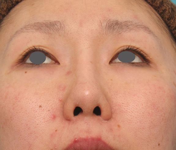 鼻翼縮小（小鼻縮小）,他院で受けた鼻の手術の修正（プロテーゼ入れ替え+耳介軟骨移植+小鼻縮小）の症例写真,After（6ヶ月後）,ba_nose_modify022_b04.jpg