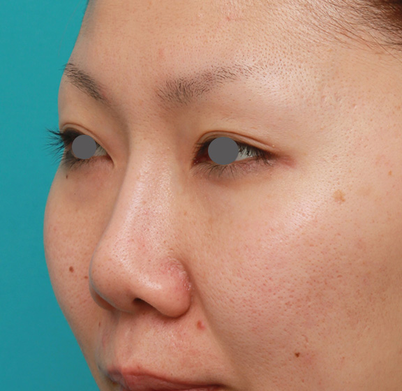 鼻のシリコンプロテーゼ抜き（除去）,他院で受けた鼻の手術の修正（プロテーゼ入れ替え+耳介軟骨移植+小鼻縮小）の症例写真,Before,ba_nose_modify022_b02.jpg