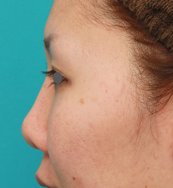 鼻翼縮小（小鼻縮小）,他院で受けた鼻の手術の修正（プロテーゼ入れ替え+耳介軟骨移植+小鼻縮小）の症例写真,Before,ba_nose_modify022_b03.jpg