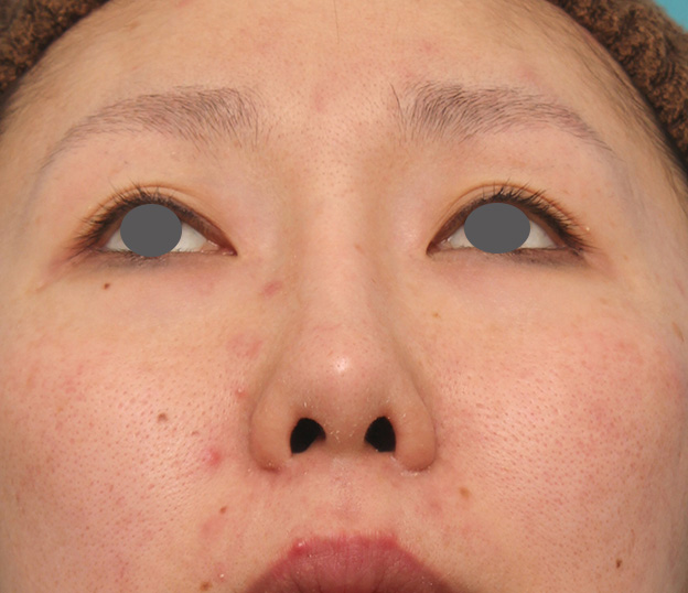 隆鼻術（シリコンプロテーゼ）,他院で受けた鼻の手術の修正（プロテーゼ入れ替え+耳介軟骨移植+小鼻縮小）の症例写真,6ヶ月後,mainpic_nose_modify022h.jpg