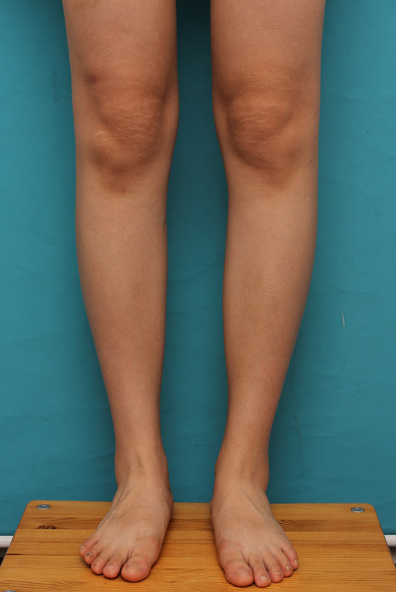 ボツリヌストキシン注射（ふくらはぎ・足やせ・美脚）,ふくらはぎボツリヌストキシン注射で、細い脚を更に細くした症例写真,After（注射後3ヶ月後）,ba_leg011_b03.jpg