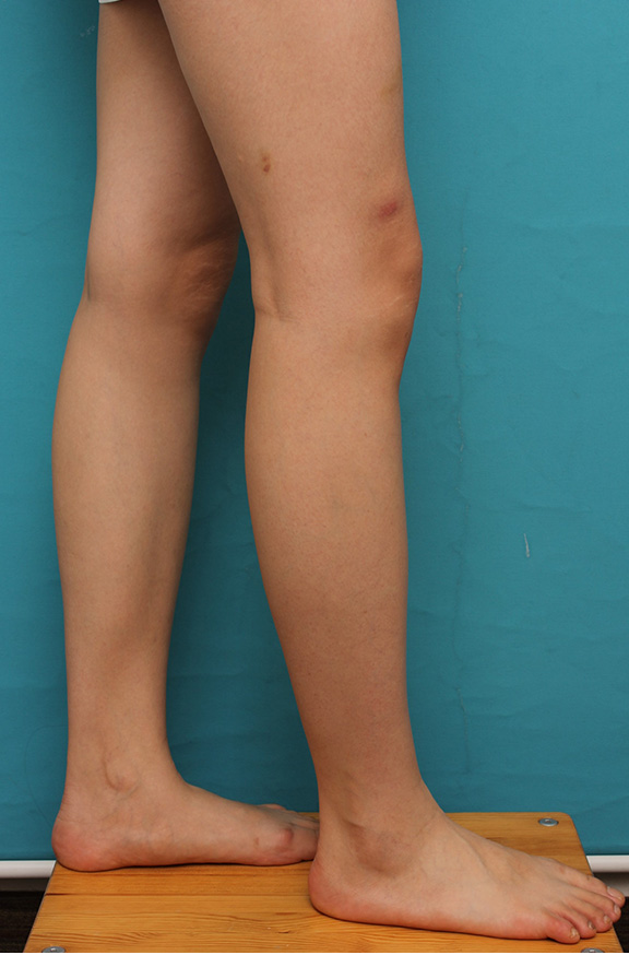 ボツリヌストキシン注射（ふくらはぎ・足やせ・美脚）,ふくらはぎボツリヌストキシン注射で、細い脚を更に細くした症例写真,After（注射後3ヶ月後）,ba_leg011_b05.jpg