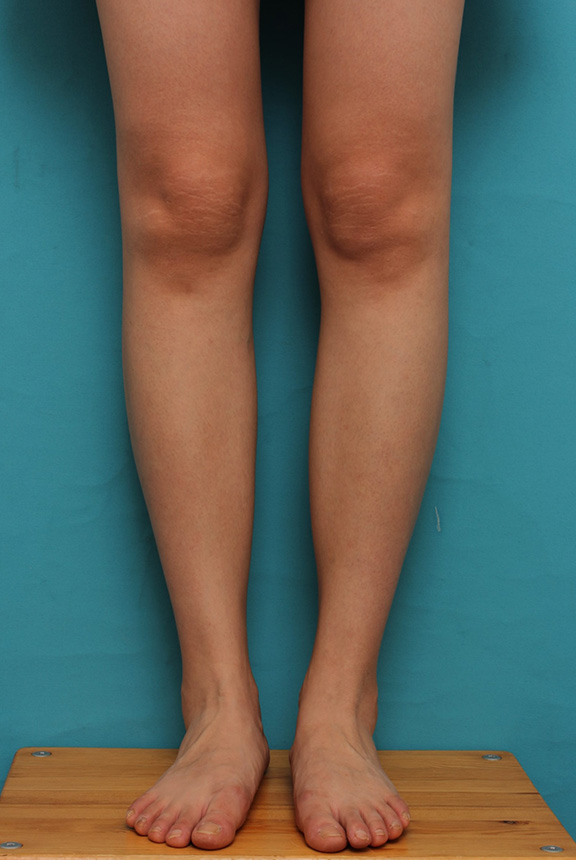 ボツリヌストキシン注射（ふくらはぎ・足やせ・美脚）,ふくらはぎボツリヌストキシン注射で、細い脚を更に細くした症例写真,Before,ba_leg011_b03.jpg