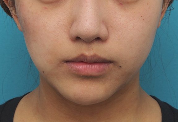 鼻の下を短く（上口唇短縮手術、上口唇リフト、リップリフト、人中短縮術）,上口唇リフト（人中短縮、リップリフト）で長い鼻の下を短くした症例写真,After（6ヶ月後）,ba_hanashita001_b01.jpg