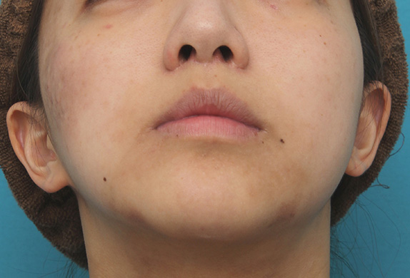 鼻の下を短く（上口唇短縮手術、上口唇リフト、リップリフト、人中短縮術）,上口唇リフト（人中短縮、リップリフト）で長い鼻の下を短くした症例写真,After（6ヶ月後）,ba_hanashita001_b02.jpg