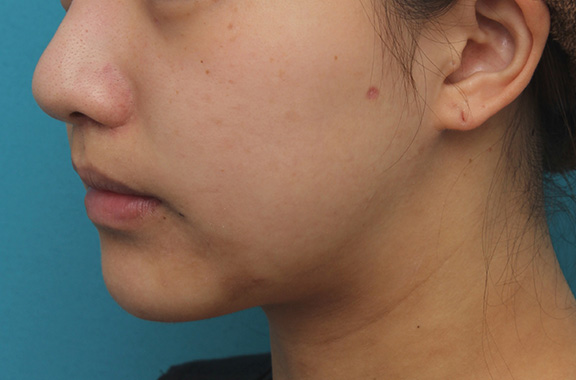 鼻の下を短く（上口唇短縮手術、上口唇リフト、リップリフト、人中短縮術）,上口唇リフト（人中短縮、リップリフト）で長い鼻の下を短くした症例写真,After（6ヶ月後）,ba_hanashita001_b03.jpg