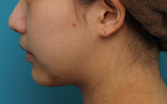 鼻の下を短く（上口唇短縮手術、上口唇リフト、リップリフト、人中短縮術）,上口唇リフト（人中短縮、リップリフト）で長い鼻の下を短くした症例写真,After（6ヶ月後）,ba_hanashita001_b04.jpg