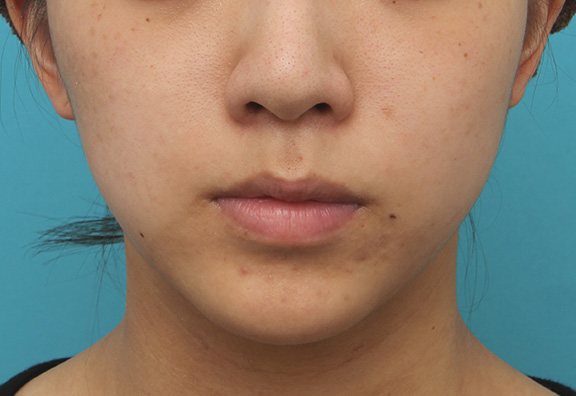 鼻の下を短く（上口唇短縮手術、上口唇リフト、リップリフト、人中短縮術）,上口唇リフト（人中短縮、リップリフト）で長い鼻の下を短くした症例写真,Before,ba_hanashita001_b01.jpg