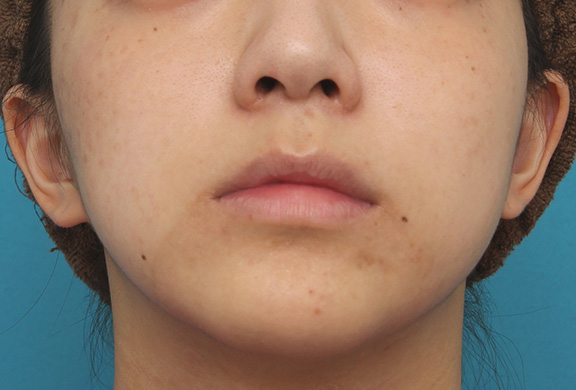 鼻の下を短く（上口唇短縮手術、上口唇リフト、リップリフト、人中短縮術）,上口唇リフト（人中短縮、リップリフト）で長い鼻の下を短くした症例写真,Before,ba_hanashita001_b02.jpg