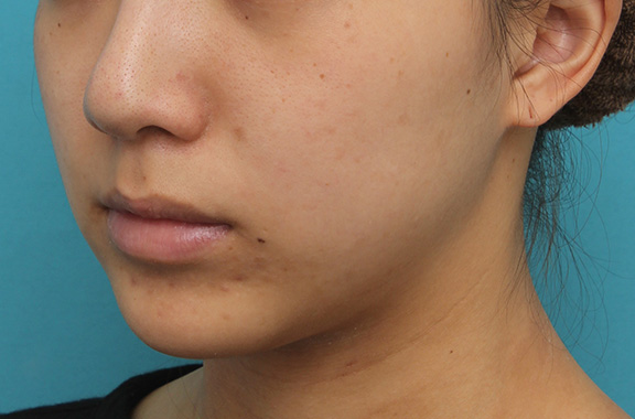 鼻の下を短く（上口唇短縮手術、上口唇リフト、リップリフト、人中短縮術）,上口唇リフト（人中短縮、リップリフト）で長い鼻の下を短くした症例写真,Before,ba_hanashita001_b03.jpg
