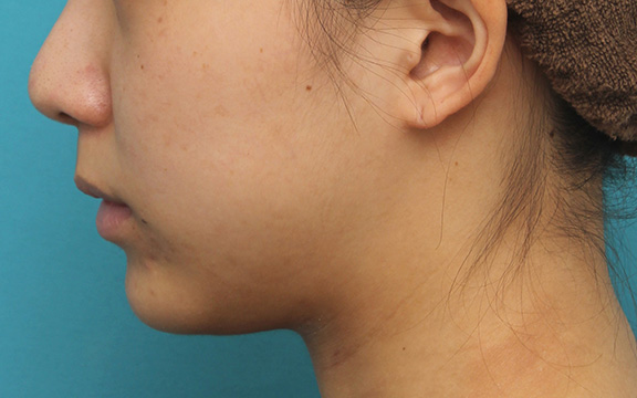 鼻の下を短く（上口唇短縮手術、上口唇リフト、リップリフト、人中短縮術）,上口唇リフト（人中短縮、リップリフト）で長い鼻の下を短くした症例写真,Before,ba_hanashita001_b04.jpg