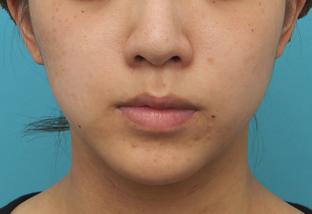 鼻の下を短く（上口唇短縮手術、上口唇リフト、リップリフト、人中短縮術）,上口唇リフト（人中短縮、リップリフト）で長い鼻の下を短くした症例写真,手術前,mainpic_hanashita001a.jpg