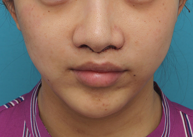 鼻の下を短く（上口唇短縮手術、上口唇リフト、リップリフト、人中短縮術）,上口唇リフト（人中短縮、リップリフト）で長い鼻の下を短くした症例写真,手術直後,mainpic_hanashita001b.jpg