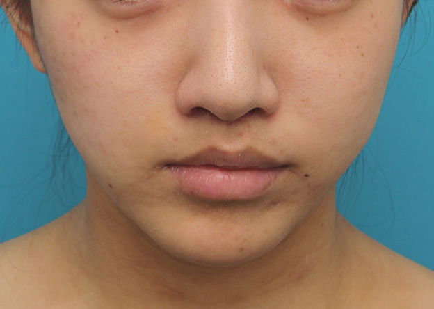 鼻の下を短く（上口唇短縮手術、上口唇リフト、リップリフト、人中短縮術）,上口唇リフト（人中短縮、リップリフト）で長い鼻の下を短くした症例写真,6日後,mainpic_hanashita001c.jpg