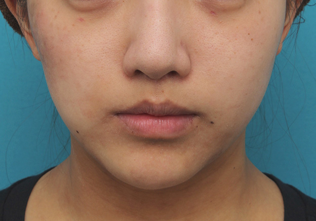 鼻の下を短く（上口唇短縮手術、上口唇リフト、リップリフト、人中短縮術）,上口唇リフト（人中短縮、リップリフト）で長い鼻の下を短くした症例写真,6ヶ月後,mainpic_hanashita001e.jpg