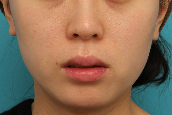 ヒアルロン酸で唇を厚く（ふっくら・アヒル口etc）,上下の唇にヒアルロン酸を注射し、薄い唇を厚くセクシーにした症例写真,After（1ヶ月後）,ba_atsuku016_b02.jpg