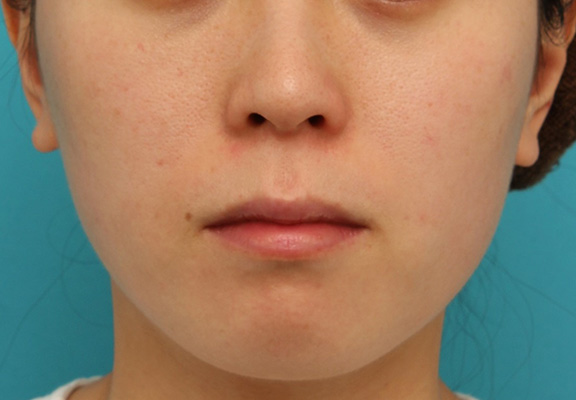 ヒアルロン酸で唇を厚く（ふっくら・アヒル口etc）,上下の唇にヒアルロン酸を注射し、薄い唇を厚くセクシーにした症例写真,Before,ba_atsuku016_b01.jpg