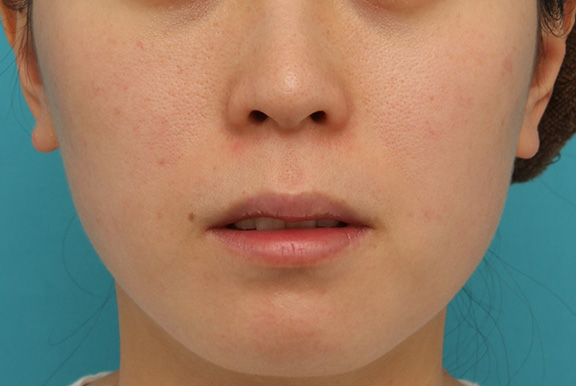 ヒアルロン酸で唇を厚く（ふっくら・アヒル口etc）,上下の唇にヒアルロン酸を注射し、薄い唇を厚くセクシーにした症例写真,Before,ba_atsuku016_b02.jpg