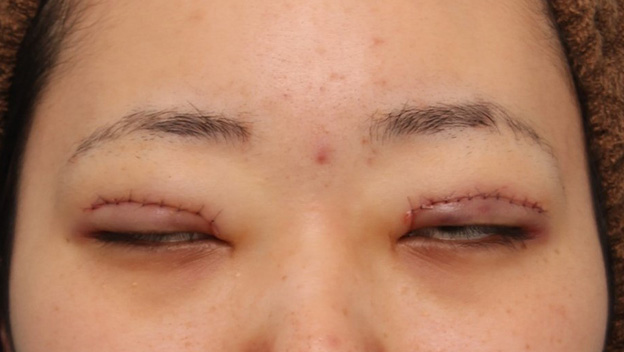 他院で受けた手術の修正（二重まぶた・目もと）,二重まぶた切開法で作られた幅広平行型二重を狭く修正手術した症例写真,手術直後,目を閉じた状態,mainpic_eye_modify022d.jpg