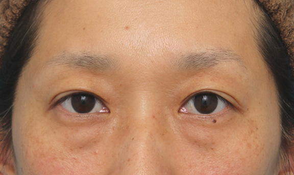 眼瞼下垂手術でまぶたの開きを良くし、自然な二重まぶたを作った症例写真,After（6ヶ月後）,ba_ganken038_a01.jpg