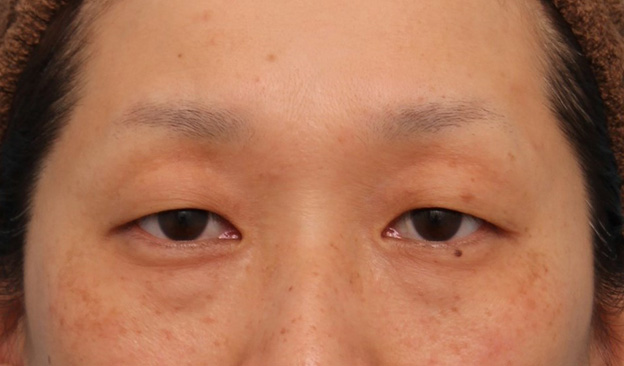 眼瞼下垂（がんけんかすい）,眼瞼下垂手術でまぶたの開きを良くし、自然な二重まぶたを作った症例写真,手術前,mainpic_ganken038a.jpg