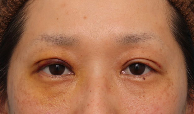 眼瞼下垂（がんけんかすい）,眼瞼下垂手術でまぶたの開きを良くし、自然な二重まぶたを作った症例写真,6日後,目を開けた状態,mainpic_ganken038d.jpg