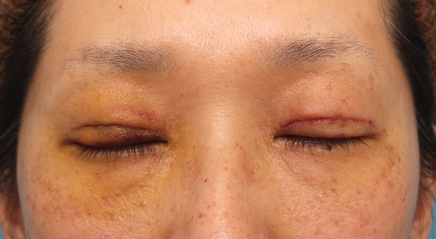 眼瞼下垂（がんけんかすい）,眼瞼下垂手術でまぶたの開きを良くし、自然な二重まぶたを作った症例写真,6日後,目を閉じた状態,mainpic_ganken038e.jpg