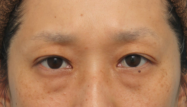 眼瞼下垂（がんけんかすい）,眼瞼下垂手術でまぶたの開きを良くし、自然な二重まぶたを作った症例写真,3週間後,目を開けた状態,mainpic_ganken038f.jpg