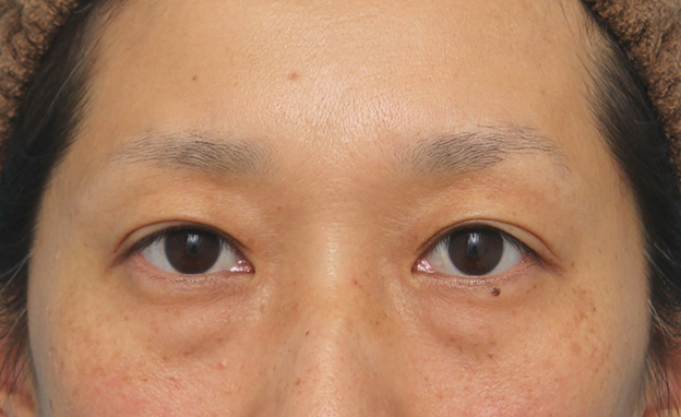 眼瞼下垂（がんけんかすい）,眼瞼下垂手術でまぶたの開きを良くし、自然な二重まぶたを作った症例写真,6ヶ月後,目を開けた状態,mainpic_ganken038h.jpg