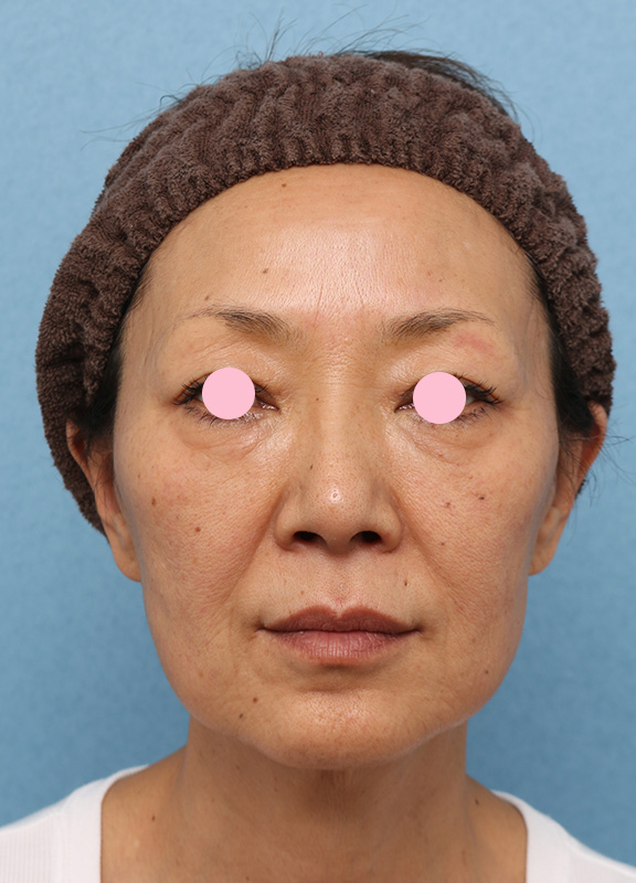 Vシェイプリフト（ヒアルロン酸注射）,フェイスラインと目の下たるみをヒアルロン酸注射で改善させた症例写真,After（1ヶ月後）,ba_v_shapelift005_a01.jpg